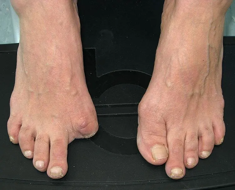 What Are Amputated Toes